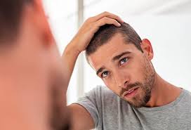 Alopecia, commonly known as baldness, is a set of disorders which involves the state of lacking hair where it would normally grow, especially on the head. How Do I Know If I Have Telogen Effluvium Or Androgenetic Alopecia