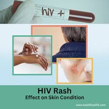 what is hiv rash symptoms
