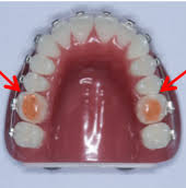 However, the gel should be specifically made for sores as certain gels that have numbing agents can worsen ulcer pain. Life With Braces Arizona Orthodontist Advanced Orthodontics