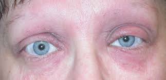 eyelid dermais xeroderma of the