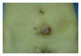 However, it is possible to develop an abnormal scar, especially if you have a. Clear Cell Carcinoma Arising From Cesarean Section Scar Endometriosis Case Report And Review Of The Literature
