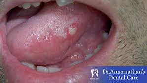 tongue ulcer causes symptoms treatment