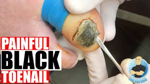 extremely damaged black toenail removal