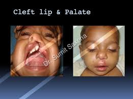 cleft lip palate and con
