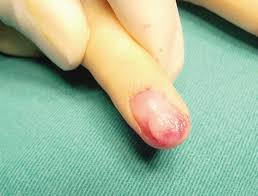 middle finger glomus tumour