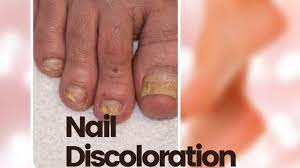 nail discoloration