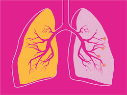 Copd Life Expectancy And Outlook What You Need To Know