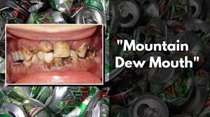 mountain dew mouth as bad as meth
