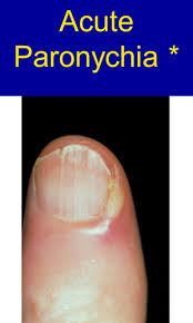 abnormal condition of nails flashcards