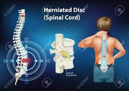 stem cell treatment for herniated discs
