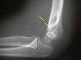 The medial epicondyle is located on the inside of the elbow. Easy Notes On Lateral Epicondyle Of Humerus Learn In Just 3 Mins Earth S Lab