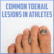 common toenail injuries in athletes