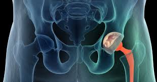 what is direct anterior hip replacement