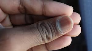black spots on fingernails