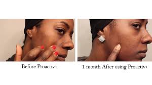 does proactiv really work 1 month