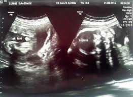 Usg atau ultrasonografi adalah pemeriksaan yang penting melalui usg, dokter dan ibu hamil dapat mengetahui kondisi janin dalam kandungan. Hasil Usg Dua Puluh Lima Minggu Dua Hari Jejak Jejak Yang Terserak