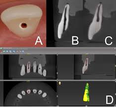 dynamic navigation in endodontics