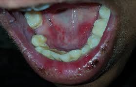 painful lesions in the mouth mpr