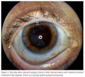Image result for icd 10 code for retained lens material right eye
