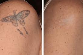 tattoo camouflage removal micro
