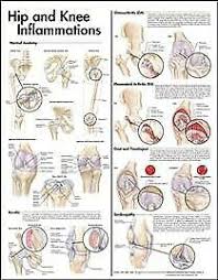 Hip And Knee Inflammations Anatomical Chart Paperback By Anatomical Chart Co 9780781773478 Ebay