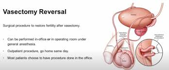 Learn about this permanent form of contraception. Vasectomy Reversals Just As Successful In Men Over 50 Z Urology