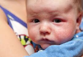 A maculopapular urticarial rash may present as early sign of disease 8 9 10 or during disease 11 without a yet known association to severity. Managing Eczema In Winter And Year Round A Parents Guide Johns Hopkins Medicine