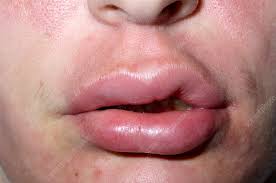 swollen lip stock image m320 0414