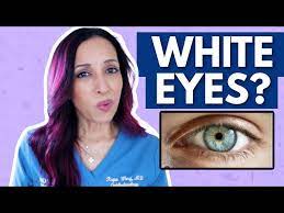 why your eyes aren t white eye doctor