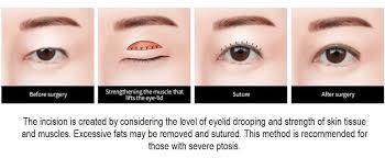 ideal eye shape with ptosis correction
