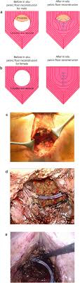 abdominoperineal resection