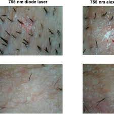 left axilla with 755 nm diode laser