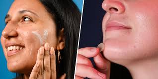 21 best acne spot treatments plus