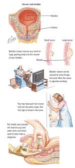 This is the most common symptom of bladder cancer and occurs in the vast majority of people with bladder cancer. Bladder Cancer Spectrum Health