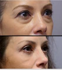 non surgical facelift rutherford nj