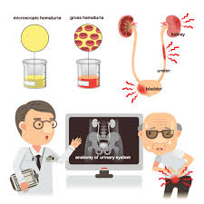 Your Urine And Diabetes What You Should Know