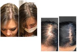 female hair loss treatment in phoenix