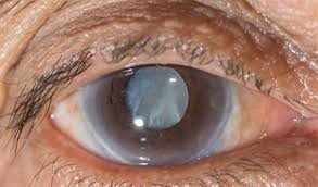 cataract surgery do you have cataract