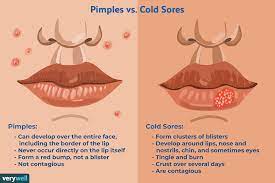 cold sore vs pimple how to tell the