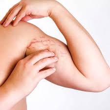 stretch marks removal singapore laser