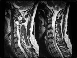 herniated disc causes neck pain