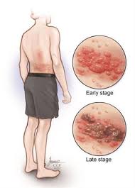 The flu is very common, and most people have experienced it at least once in the. Shingles Herpes Zoster Symptoms Treatment Prevention