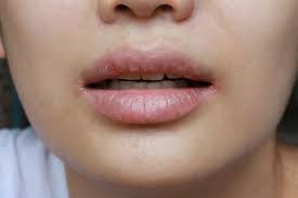 Jika bibir anda berwarna merah muda dan sekarang berubah menjadi gelap di antara banyak cara memerahkan bibir hitam secara alami untuk memilih salah satu cara mudah untuk membuat. Angular Cheilitis Luka Di Sudut Bibir Penyebab Dan Pengobatan