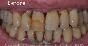 brown spots on teeth causes
