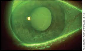Ophthalmology Management Dry Eye As