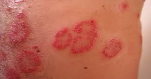 psoriasis rana cure homeopathy