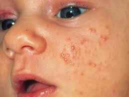 heat rash in es and toddlers how