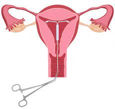 mirena iud removal removal side