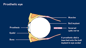 enucleation removal of an eye