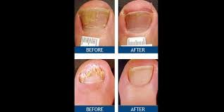 new fda approved treatment for nail fungus